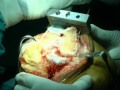 Live Knee Replacement Surgery