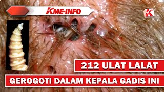 Dokter Keluarkan 212 Ulat Lalat Memat1Kan Yg Ger0Goti Kepala Gadis Ini