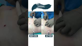 Liposuction And J Plasma