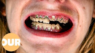 Can My Rotten Teeth Be Saved? Our Life