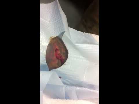 Arm abscess lancing and cleaning -VERY GRAPHIC