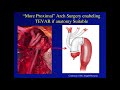 STS University 2019 - Course 2: TEVAR and Aortic Arch Debranching Procedures