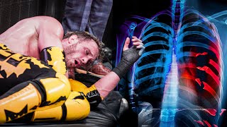 I Broke My Ribs At Summerslam