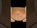 Mommy Makeover Surgery - Tummy Tuck Surgery - Liposuction