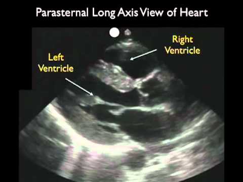 Cardiac Ultrasound - Parasternal Long Axis - Part 1 - SonoSite, Inc