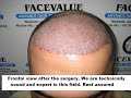 hair transplantation in India