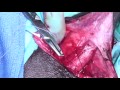 Inflatable Penile Implant - Penile Prosthesis Surgery - Rafael E. Carrion MD