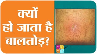 बलतड यन Boils हन क व वजह नह ह ज आप समझत ह Tan Ki Baatsehat Ep 139