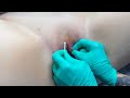 The q-tip test for VCH (vertical hood) piercing suitability