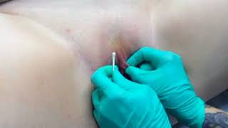 The q-tip test for VCH (vertical hood) piercing suitability