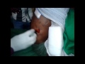 Incision & Drainage Back Abscess