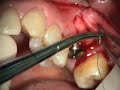 Implant Microsurgery: Molar Implant and AlloDerm Augmentation