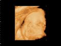 ultrasound 3d 4d
