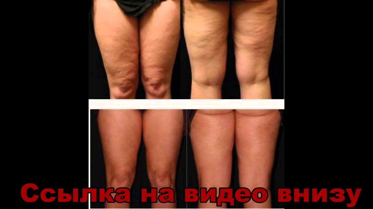 Как избавиться от целлюлита в домашних условиях? 5 Как избавиться от целлюлита в домашних условиях? 7