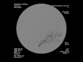 micro catheter