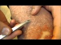 Tweezing Moisturized Psoriasis Scales