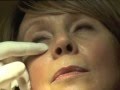 Le traitement des cernes sans chirurgie