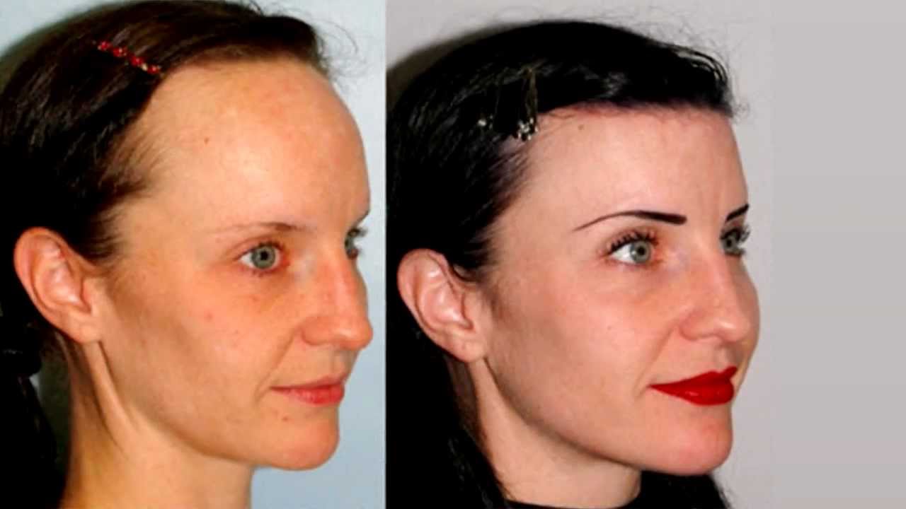 B12 and facial hair growth