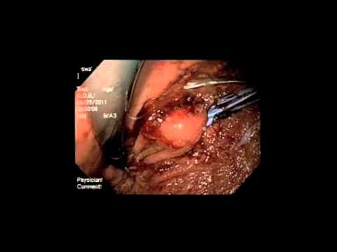 gastric symptoms yahoo