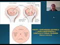 Patología Benigna anorrectal: Fisura anal