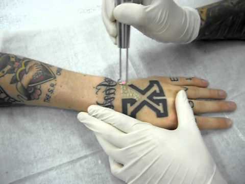 Laser Tattoo Removal - Removing straight edge tattoos - YouTube