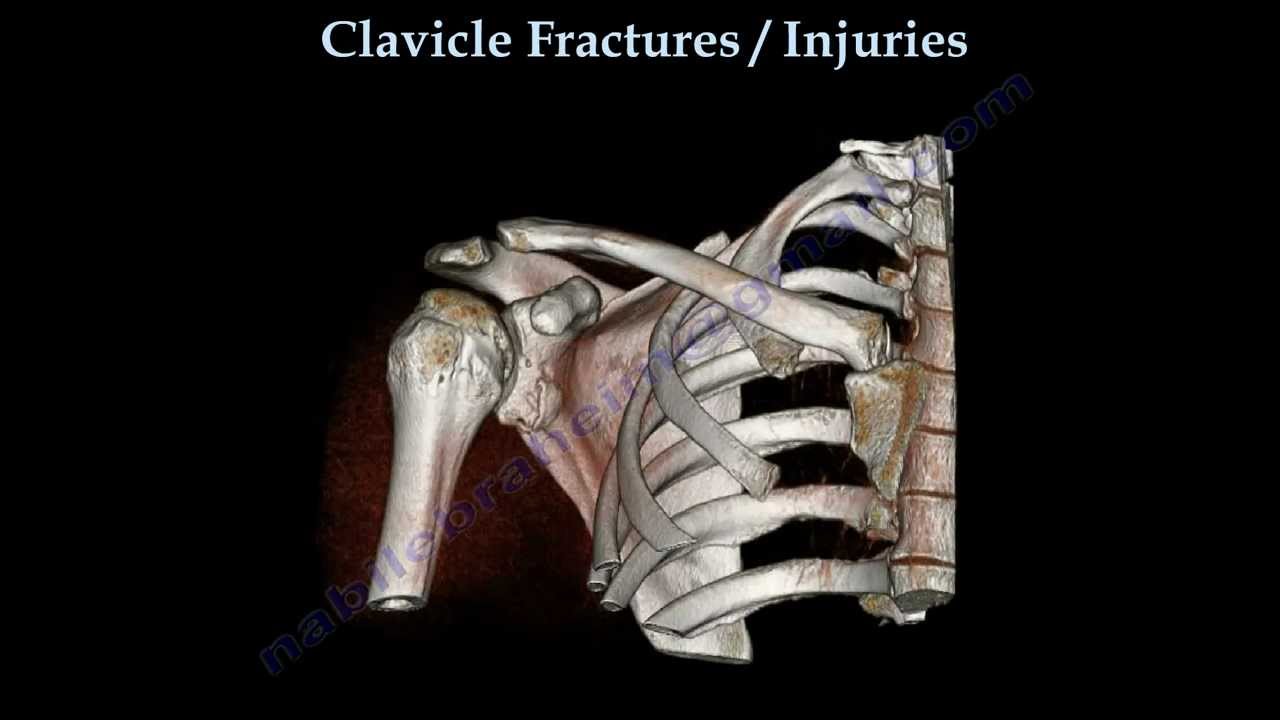 CLAVICLE FRACTURE treatment and repair - Everything You Need To Know