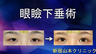 眼瞼下垂術 山本クリニック