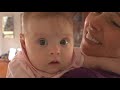 Down's syndrome