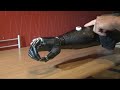 Bionic hand gives a new lease of life