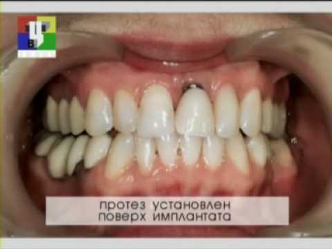 Имплантация зубов в медси Имплантация зубов в медси