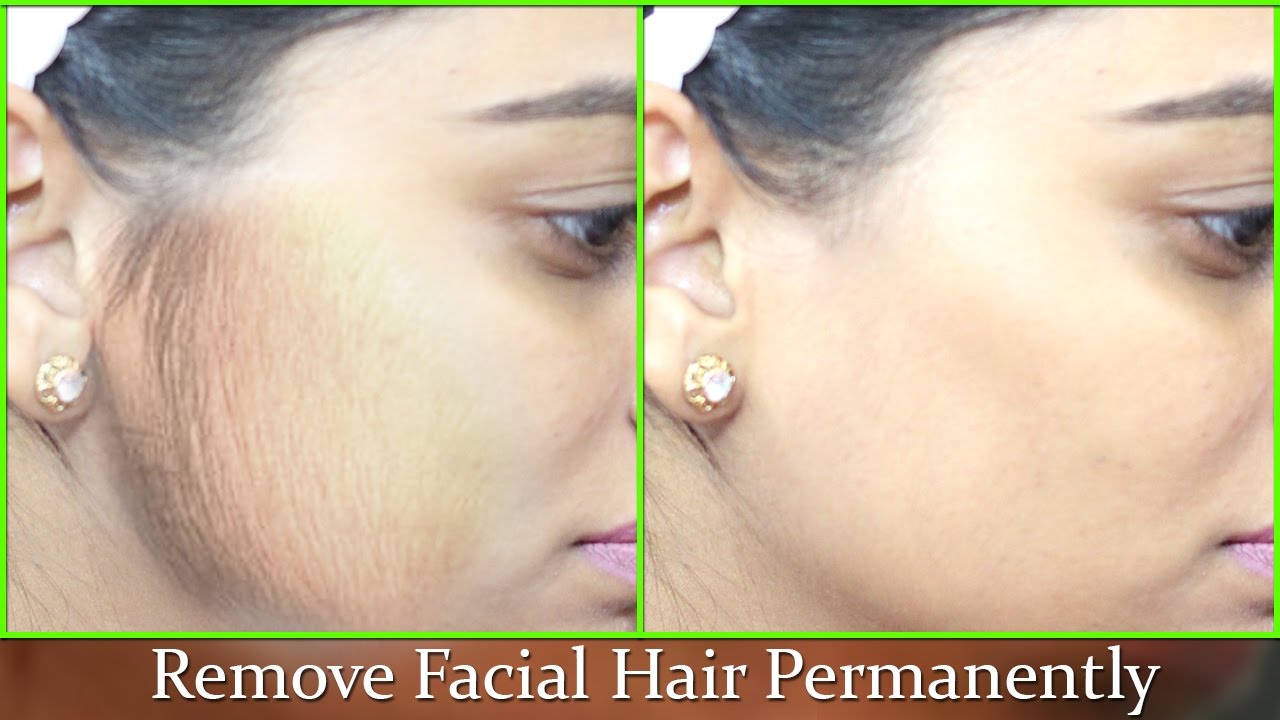 Facial hair nyc removal