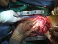 Heartmate II LVAD Implantation. Arie Blitz, MD