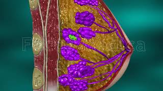 In Situ Carcinoma - Animated Atlas Of Breast And Gastric Cancer