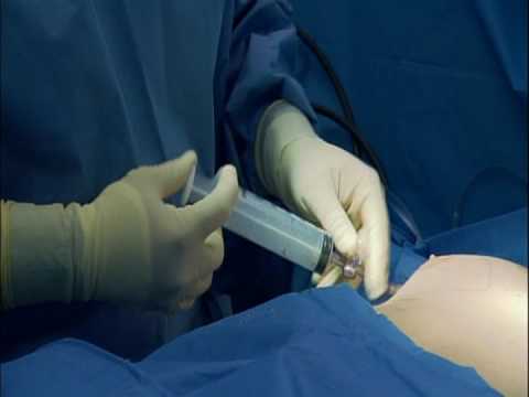 What is sex change surgery video