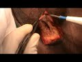 Penectomy
