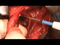 Penectomy