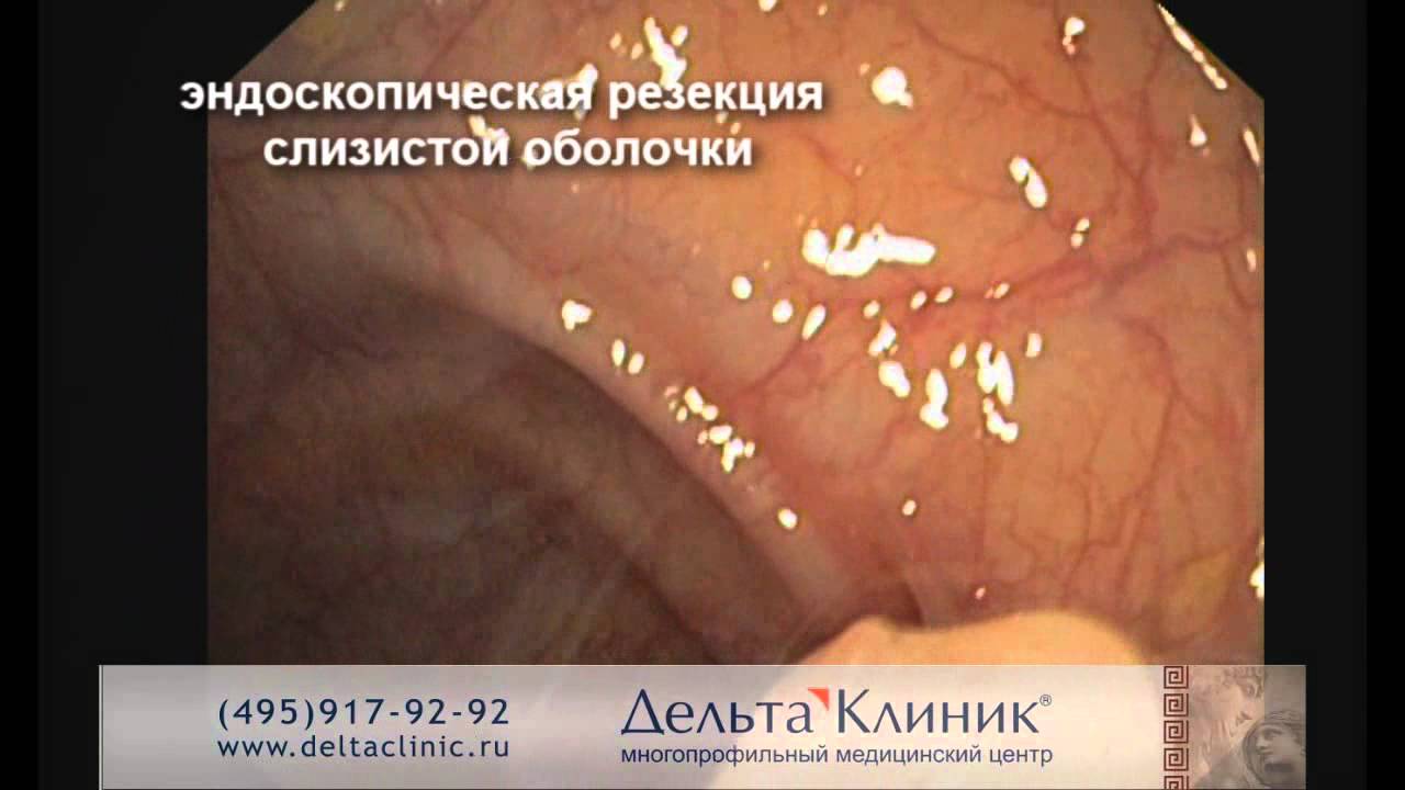 эндоскопическое увеличение груди эндоскопическое увеличение груди