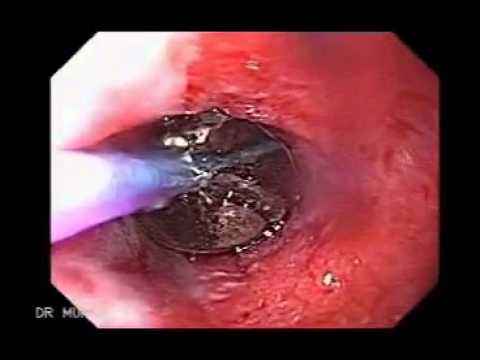stomach cancer surgery games
