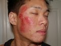 How to Treat Your Acne Scars at Home!