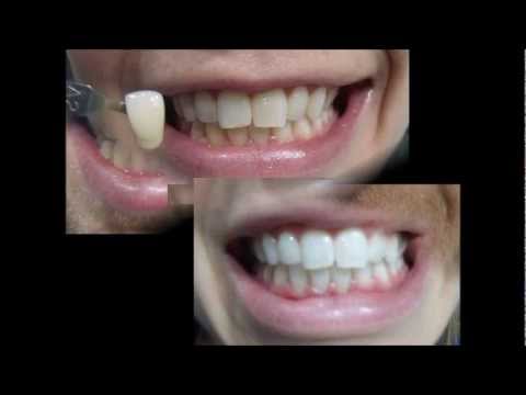 whitening teeth zoom before