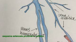Accesos Vasculares Para Hemodiálisis Reimplante V Cefálica