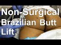 Non-Surgical Brazilian Butt Lift - Sculptra Injection - Dr. Paul Ruff | West End Plastic Surgery