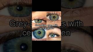 I Have Central Heterochromia Eyes