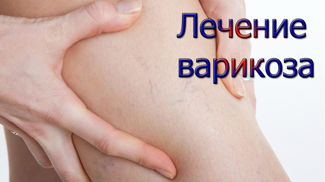 Лечение варикоз вен в домашних условиях Лечение варикоз вен в домашних условиях