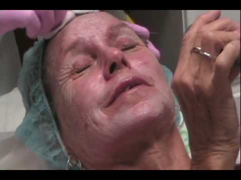 renee from mob wives face peel. 33 Glycolic acid facial peel