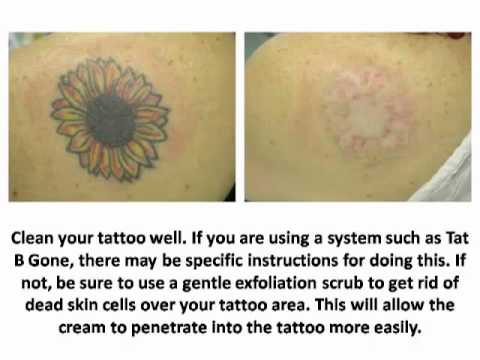How to Remove a Tattoo With Home Remedies - Tattoo Removal ...