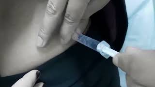 how to do an intramuscular injection in the buttock.  intramuscular injection