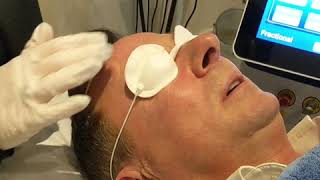 3D-Vjuve Co2 Fractional Laser Facial Overview