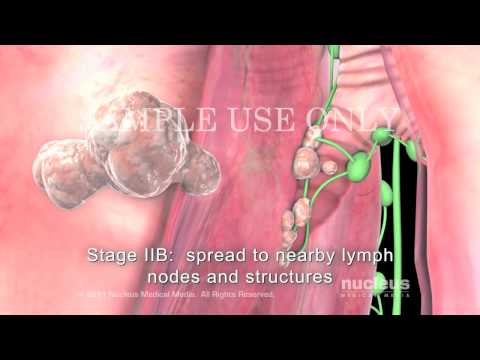 lung most cancers natural remedy