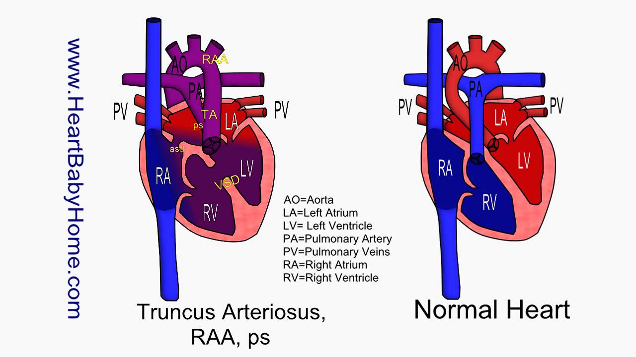 61 Truncus Arteriosus, RAA, ps YouTube